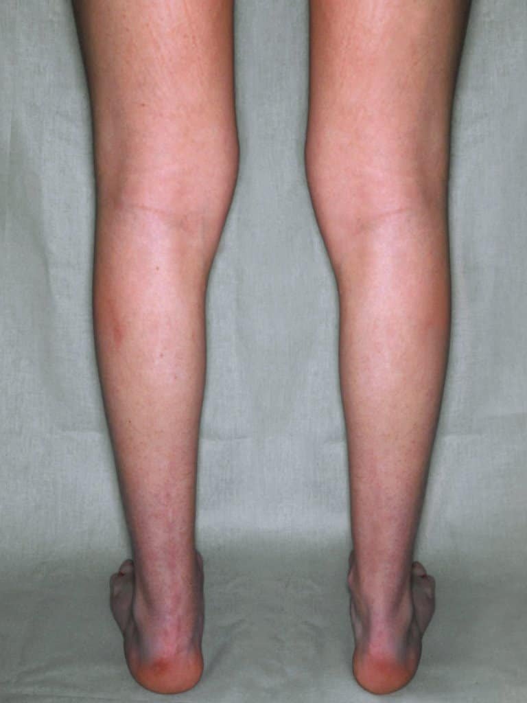 Antes de la operación de gemelos