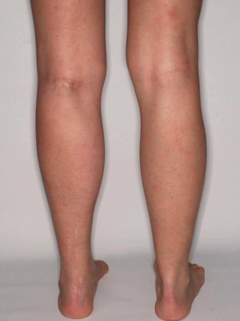 Después de la operación de gemelos