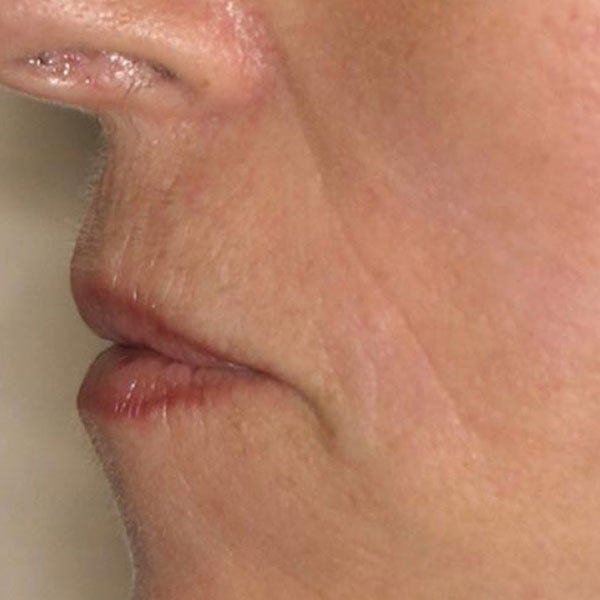 Después de la operación de pómulos