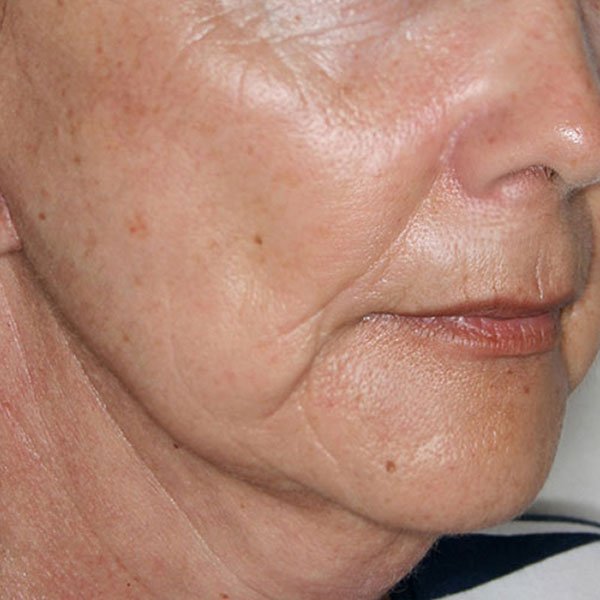 Después del lifting facial