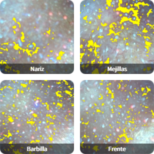 Distribución de melanina por zonas: nariz, mejillas, barbilla y frente